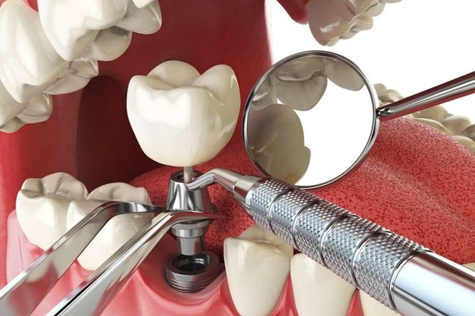 Aesthetic Advancements In Denture And Implant Dentistry